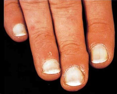 define leukonychia|What Causes White Spots on Nails and How to Treat Them .